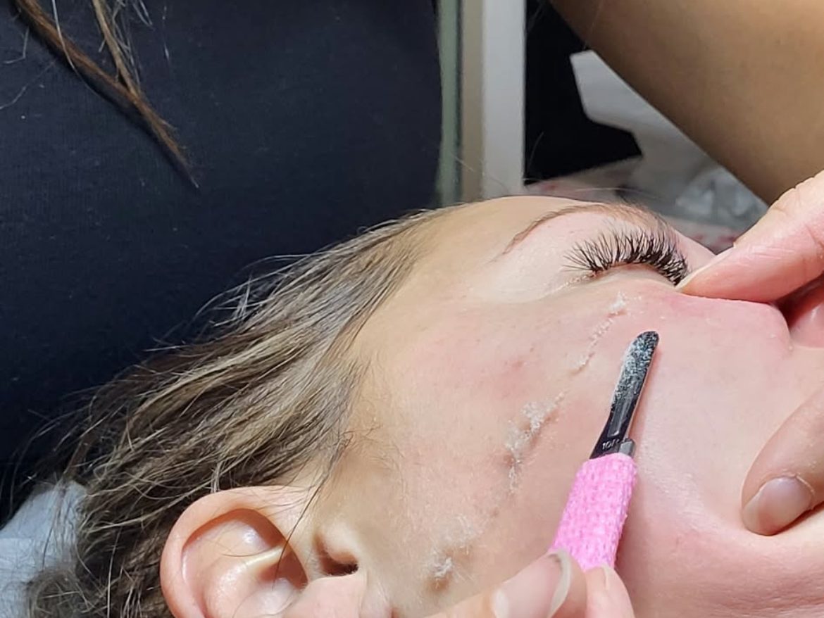 Un dermaplaning à la clinique